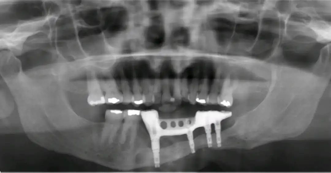 Patient #7 Rib graft and All on 4 Segmental Hybrid for a cancer survival patient .005 copy