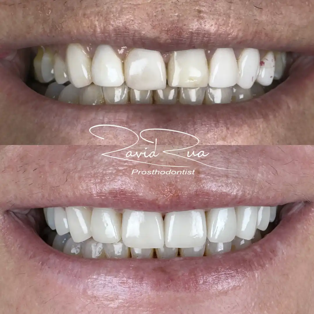 Patient #8 Top Anterior Veneers .001 copy