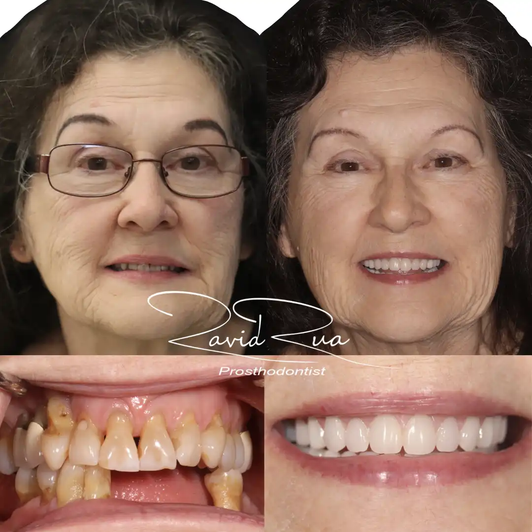 Patient #9( Top and bottom Overdentures supported by 3-4 implants .001 copy