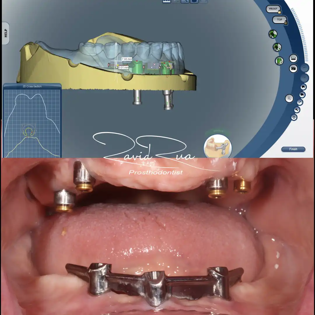 Patient #9( Top and bottom Overdentures supported by 3-4 implants .002 copy
