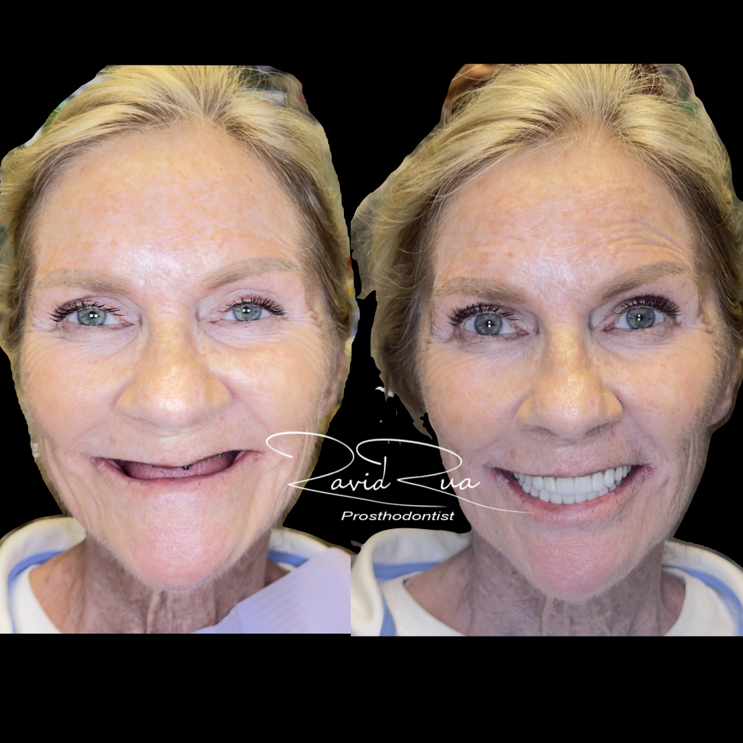 All on 6 Hybrids .001