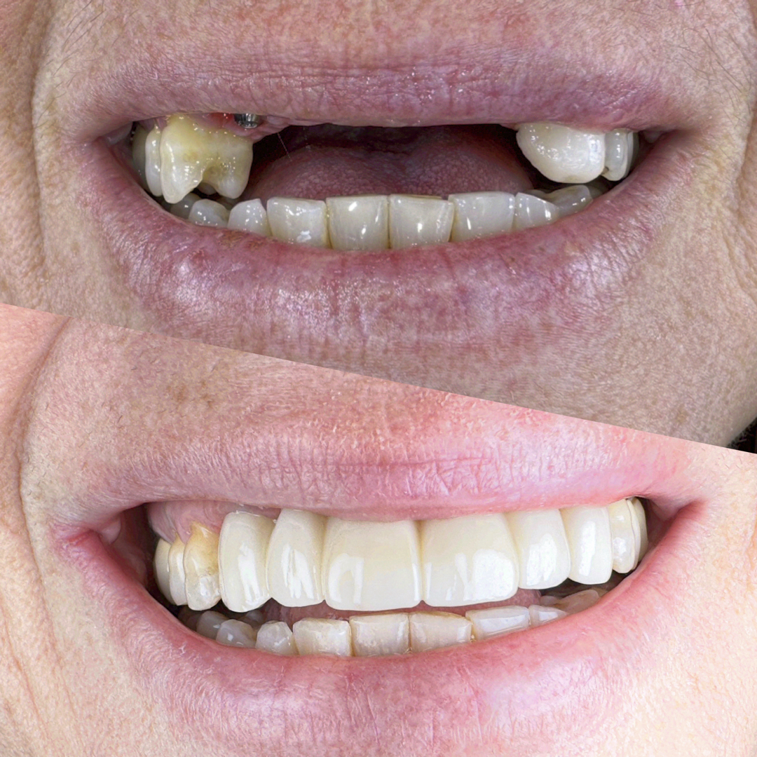 Implant supported anterior bridge 001